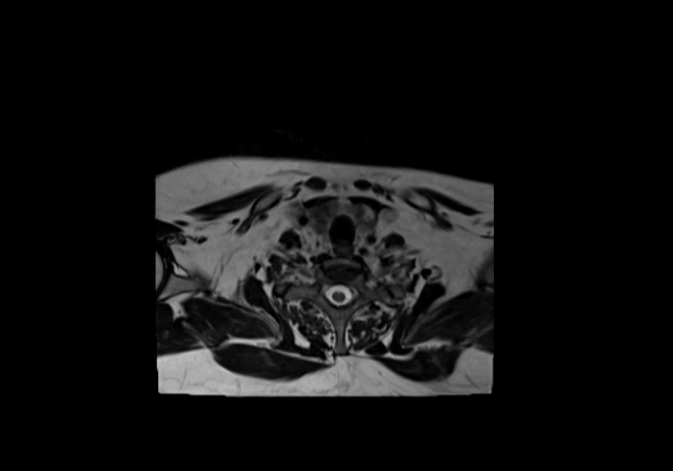 Neck axial  lymph node cross sectional MRI anatomy 3T MRI  image-img-00001-00087.webp